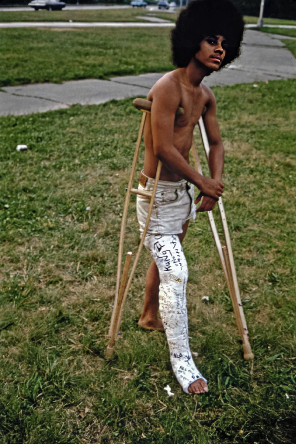 a shirtless man with crutches and a broken leg