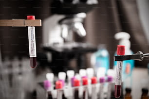 中国・武漢からのCOVID-19検査と診断のための血液検査の検査サンプル 新しいコロナウイルス感染症(新しいコロナウイルス病2019)。パンデミック感染の概念