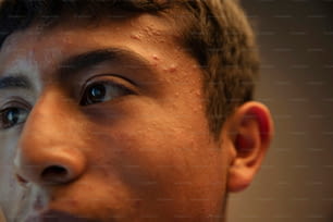 a close up of a young man with acne on his face